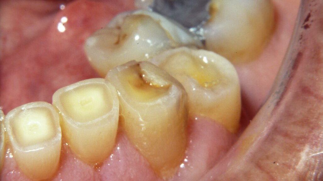 דיאטה אינה האשמה היחידה בגרימת ארוזיה בשיניים