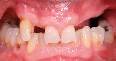 Riabilitazione implanto-protesica dei siti atrofici del mascellare. Alternative terapeutiche al grande rialzo di seno mascellare