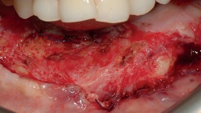Periimplant soft-tissue management in patients with a fibula free flap reconstruction: Case series and description of a new technique Periimplant soft-tissue management in patients with a fibula free flap reconstruction: Case series and description of a new technique