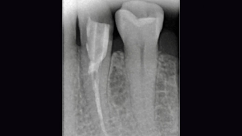 Fig. 2. Estado tras la revisión, la colocación de la espiga y la reconstrucción.