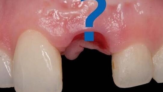 Sposoby zaopatrywania zębodołu poekstrakcyjnego