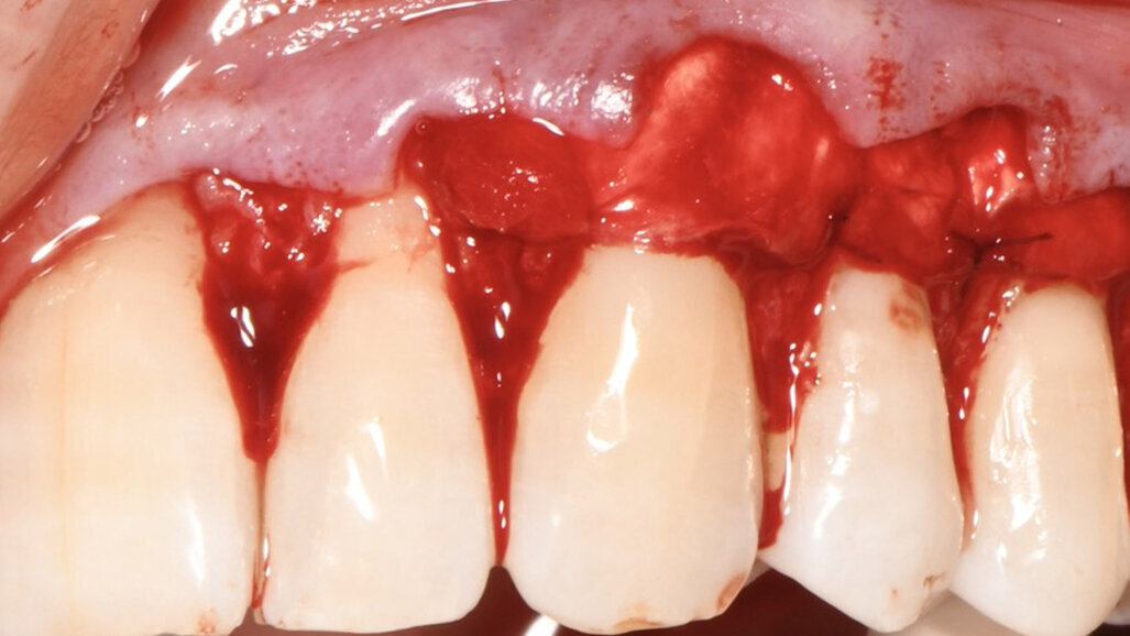 Trattamento di recessioni gengivali multiple mediante tecnica MCAF associata all’utilizzo di una matrice tridimensionale collagenica