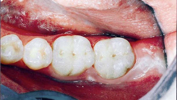 Gli scienziati dichiarano che la CUS è una malattia autoimmune