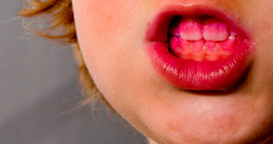 Il grafene rallenta la carie e la malattia parodontale