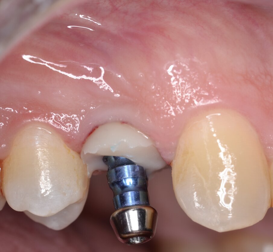 Fig. 22 - Transfer individualizzato in situ.