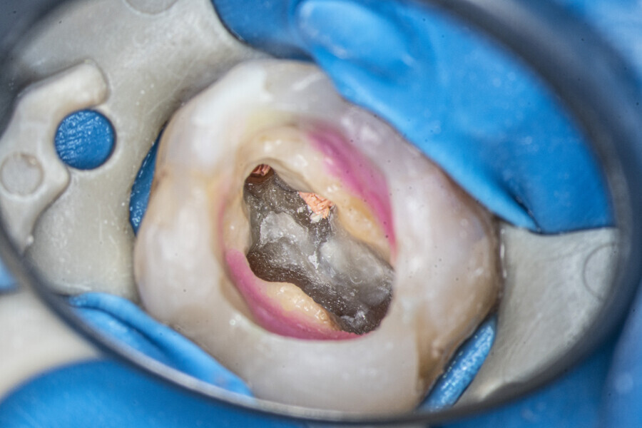 Fig. 59: The pulp chamber after obturation of the canals.