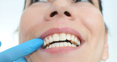 Fünfte Deutsche Mundgesundheitsstudie gestartet