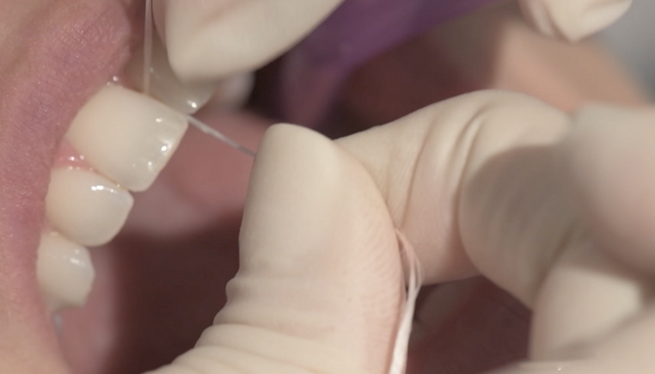 Fig. 4: Checking interdental contacts for collisions.