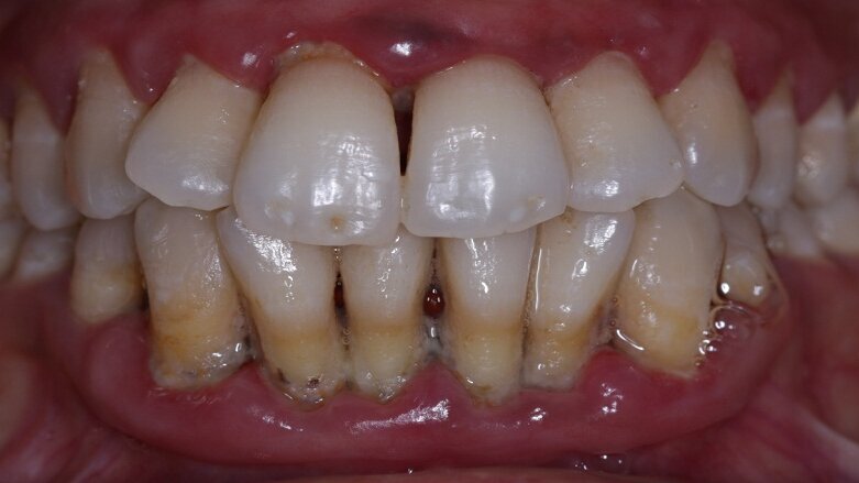 Linked: Low-level vitamin D, periodontitis and Type 2 diabetes.