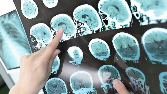 Herinnering aan dentale behandeling achtervolgt brein angstige patiënt