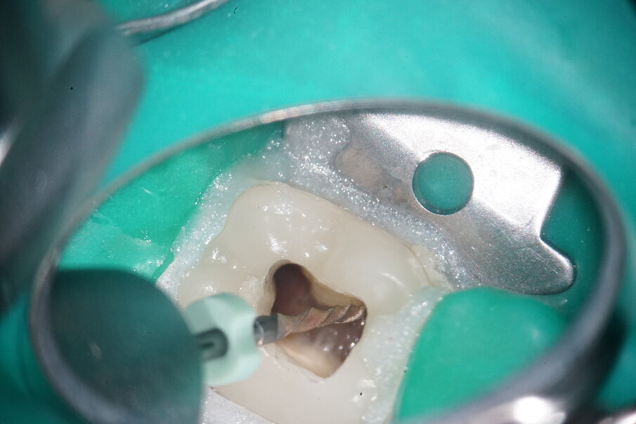 Fig. 7: Preparation with the 20/.05 file in the canal.