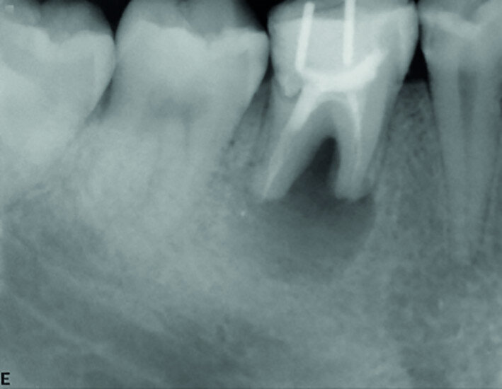 Fig. 16a: Pre-op periapical radiograph.