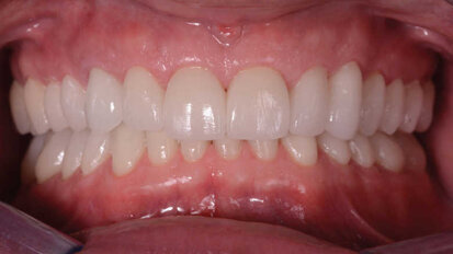 Correction de la dimension verticale d’occlusion : flux de travail numérique, scanner, CAD/CAM