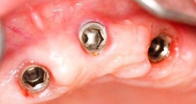FDA обмисля ново класифициране на денталните имплантати