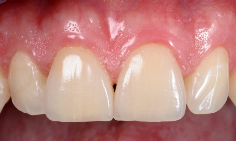 Fig. 28 One year post-op.