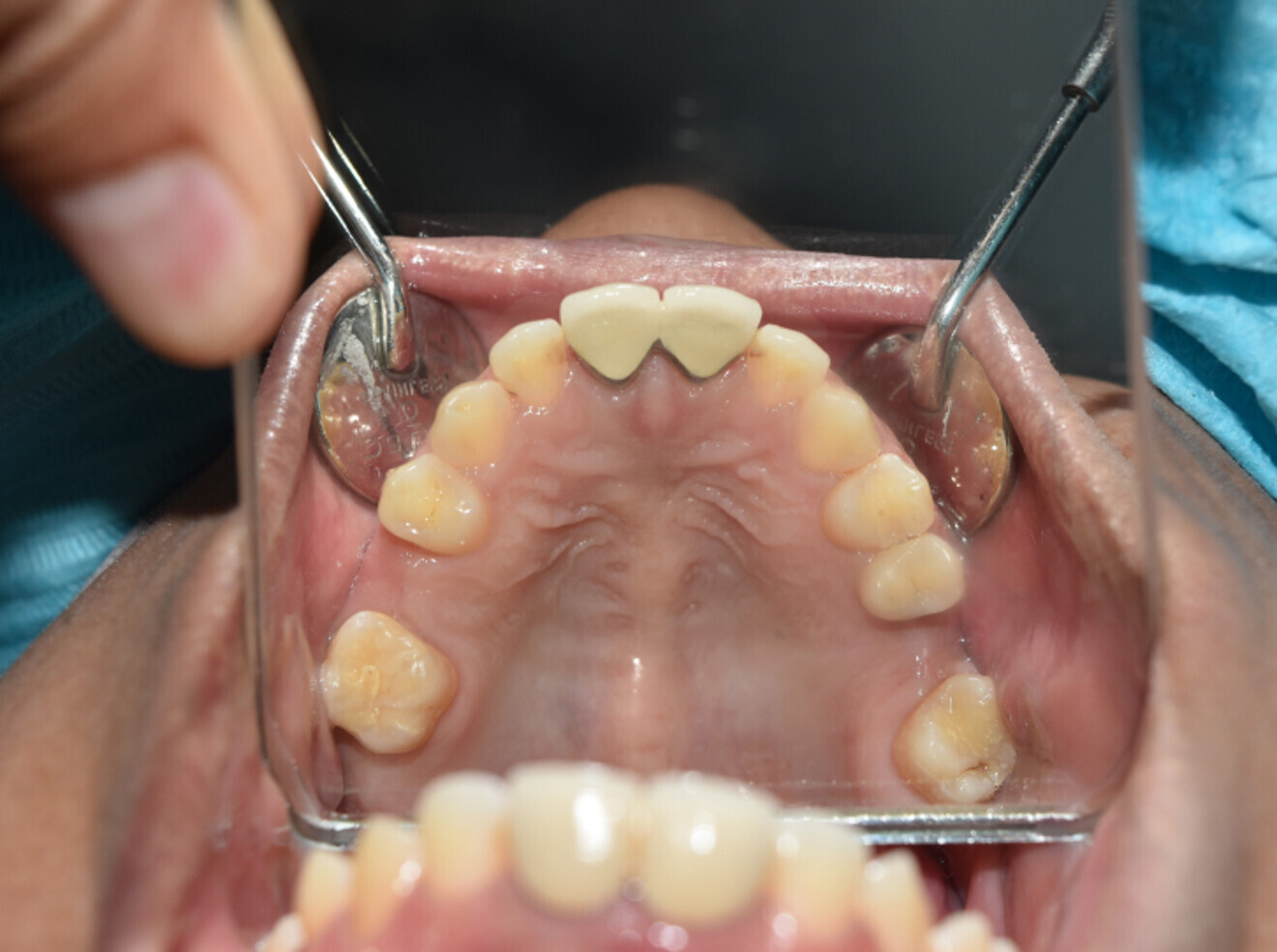 Fig. 13a: Gaps posterior maintained for future implants.