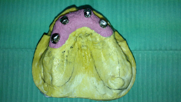 Edentulia risolta con attacco monolaterale