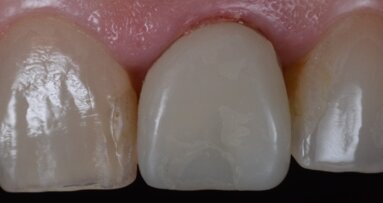 Carico immediato dell’impianto e restauro di incisivo fratturato