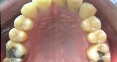 Ortodoncia invisible al alcance de todos