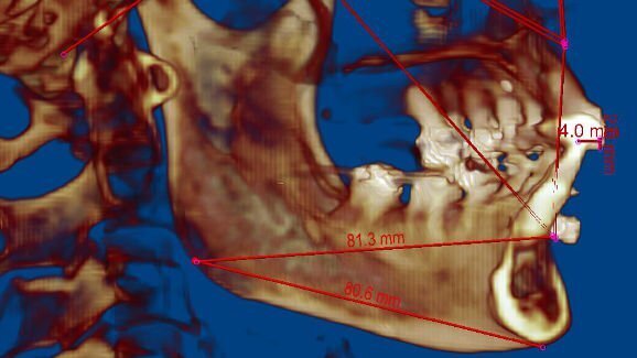 Nova tecnologia melhora alinhamento da mandíbula e dos dentes em pacientes submetidos a transplante facial