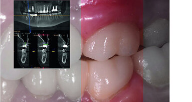 Digital workflow and application of PRF and ozone therapy in oral rehabilitation