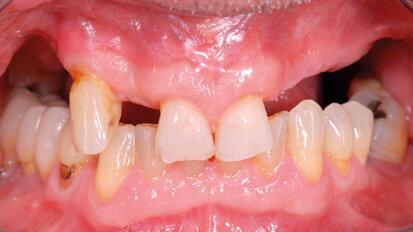 Riabilitazione implanto-protesica dei siti atrofici del mascellare. Alternative terapeutiche al grande rialzo di seno mascellare