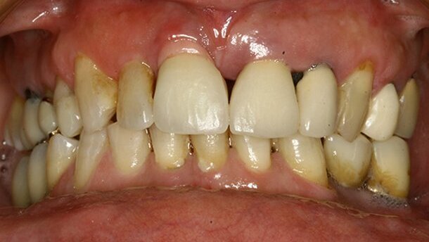 L’utilizzo di monconi in zirconio per il miglioramento dell’estetica rosa