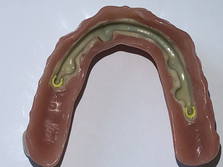 Afbeelding 11. De nieuwe staaf volledig met kunststof aangepast.