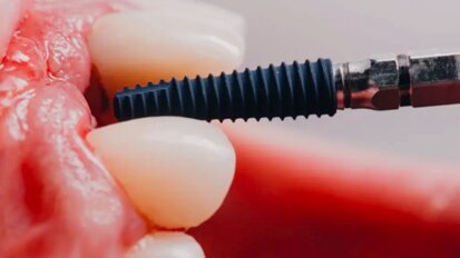 Mais de 10.000 implantes dentários colocados usando o sistema robótico Yomi