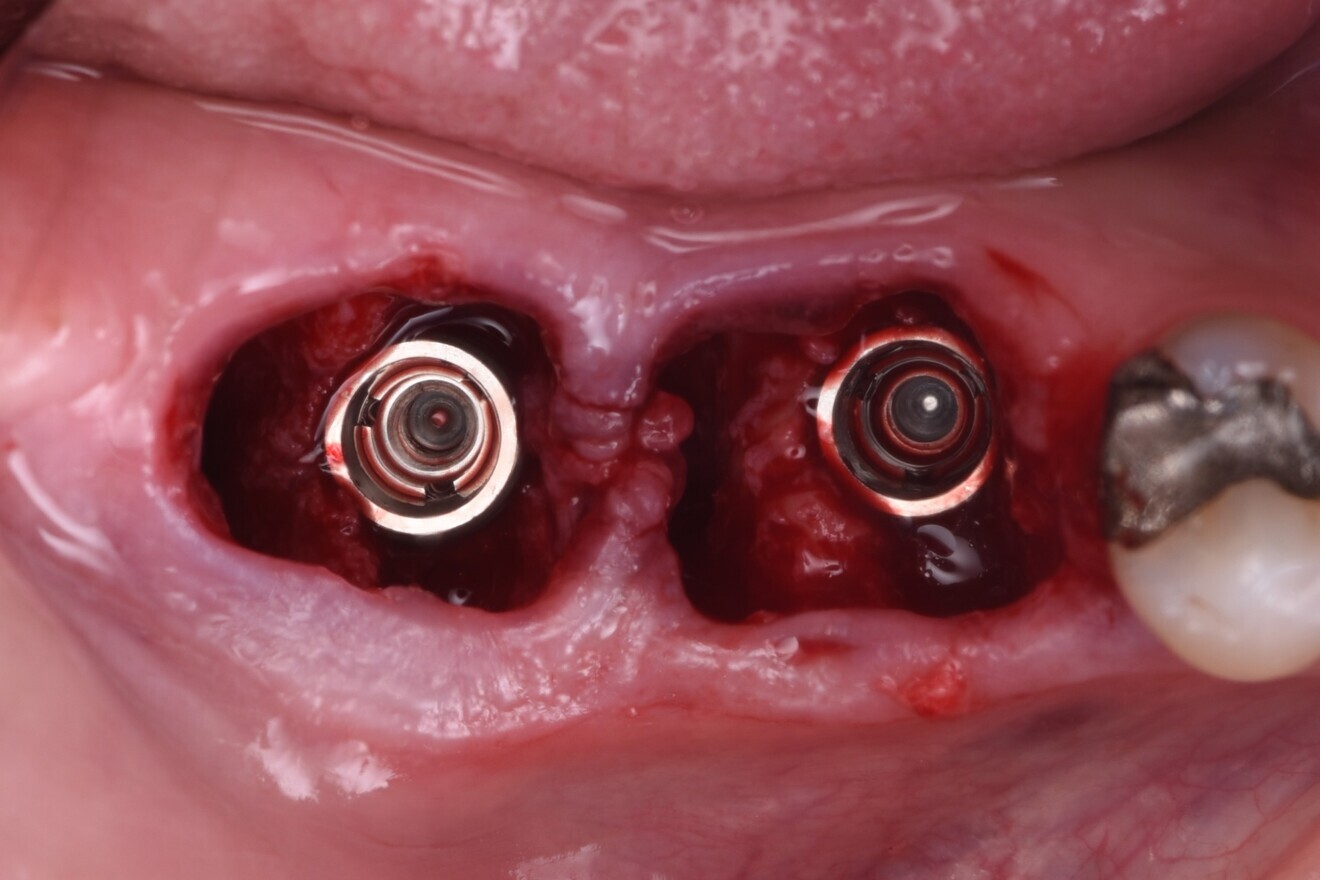 Fig. 8: Sockets thoroughly debrided. 
