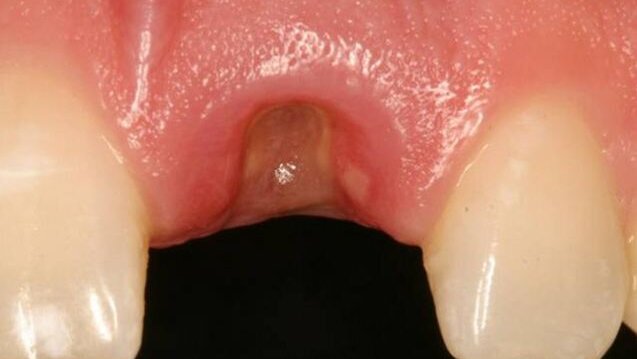 Gestion d'un implant unitaire, dans la zone esthétique