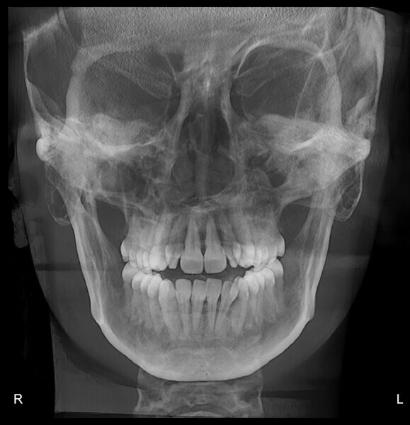 Fig. 24: Frontal radiograph after splint therapy (increased anterior open bite).