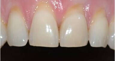 L’ipersensibilità dentinale