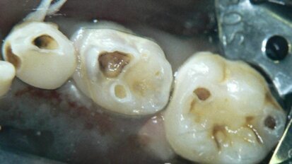 סילוק עששת סלקטיבי בנגעי עששת עמוקים לעומת סילוק עששת בשני שלבים