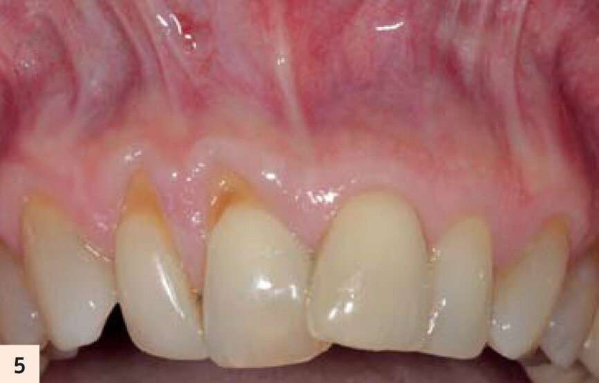 figure 5 : Vue préop. Récession traumatique de classe II Miller avec malposition dentaire associée.