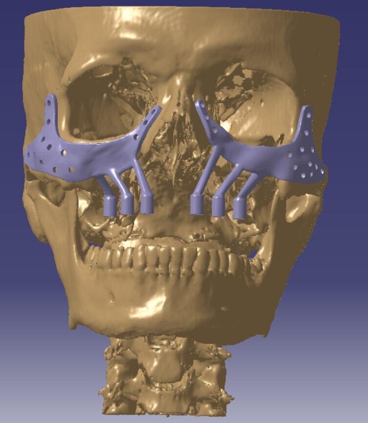 Fig 5. 3D planning with patient specific subperiosteal implants