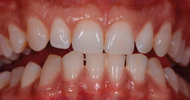 Il protocollo tailoring di sbiancamento. Per un feedback endo valutativo di un odontoiatra testimonial delle sue terapie cosmetiche. Case report