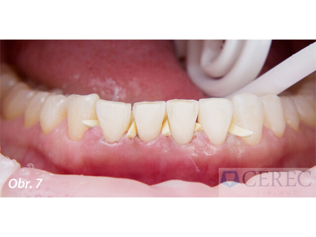 Preparace zubů dolní čelisti na fazety