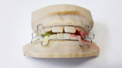 Zhotovení ortodontických aparátů na 3D tištěné modely