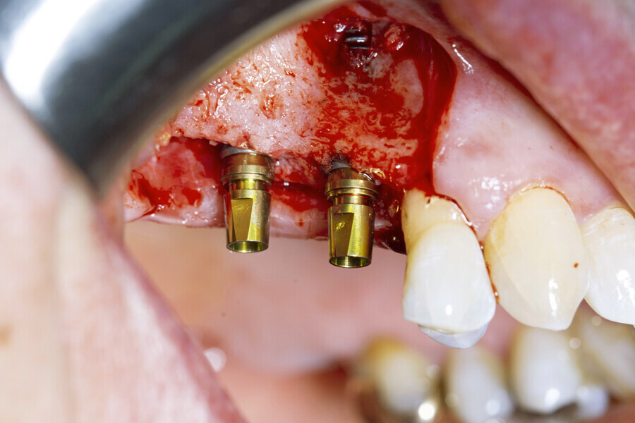 Fig. 5: Both OmniTaper EV implants placed with the help of the preassembled TempBase abutments nicely aligned in positions #15 and 16. Implant–abutment connection size of medium indicated in yellow.