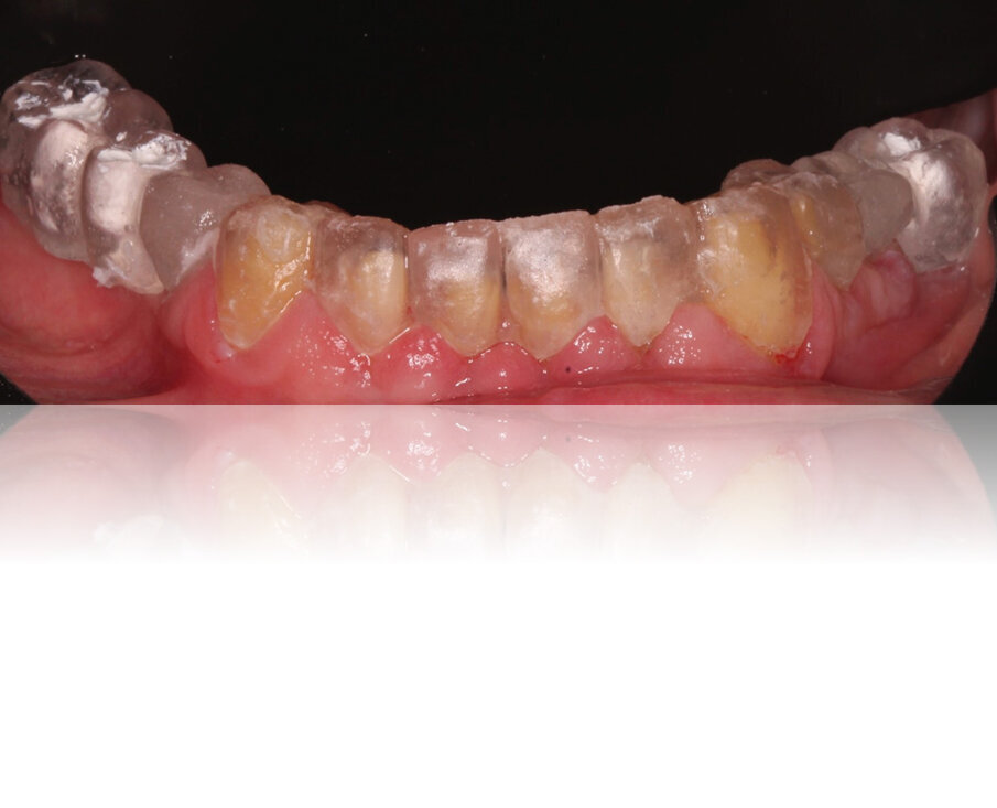 Fig. 9: X-ray template (derived from the wax-up) 
