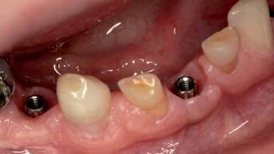 Kompromisowe leczenie implantoprotetyczne i zachowawcze w przebiegu dysplazji ektodermalnej