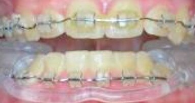 Diagnóstico y tratamiento de ATM con una nueva férula