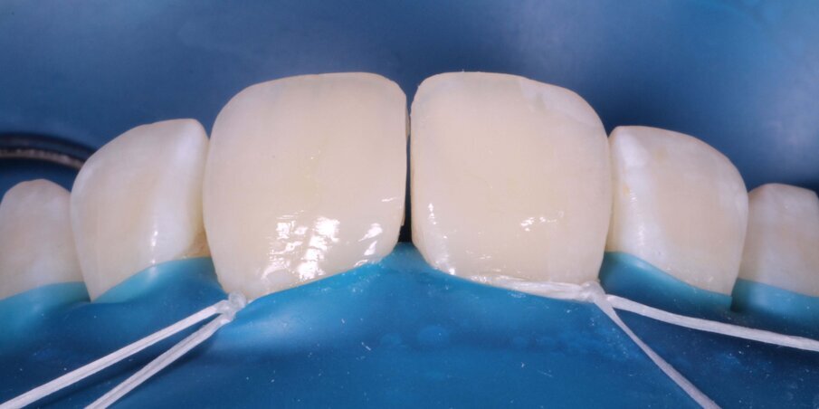 Fig 8. 21 wing. A small Space is left on purpose