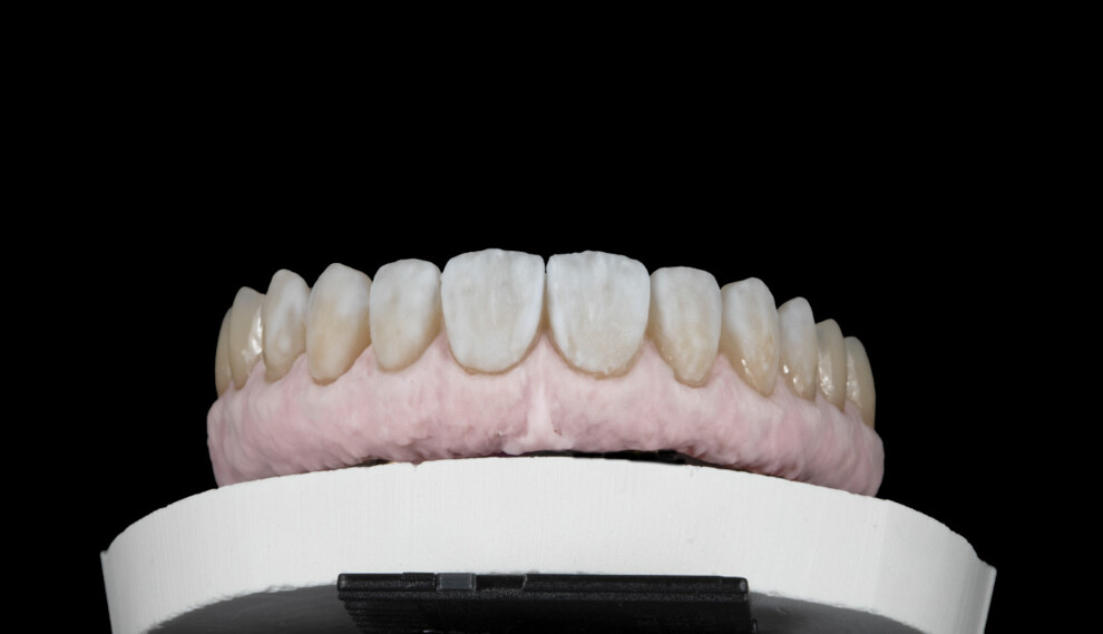 Fig. 11: Application of GC Initial Zr-FS for characterisation of the teeth and gingiva.