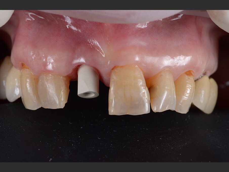 Figg. 8a, 8b - Acquisizione intraorale: visione frontale.