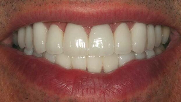 Porcelain laminate veneers: an excellent option to correct esthetic and functional problems