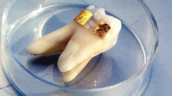 Nanosensor auf Zahnschmelz spürt Bakterien auf