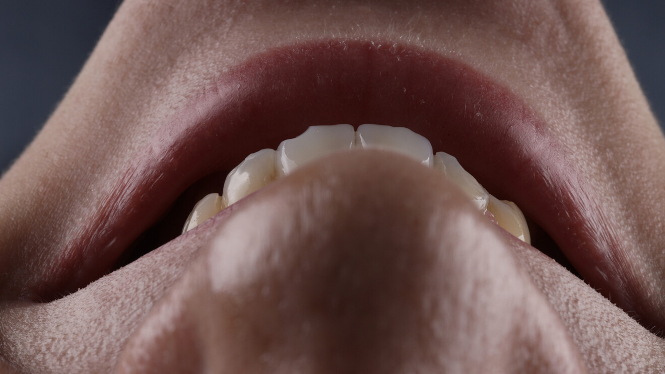 Fig. 1c: Preoperative view of the maxillary anterior restorations. Incisal view.
