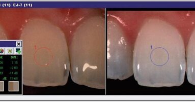 Tooth whitening: A conservative approach